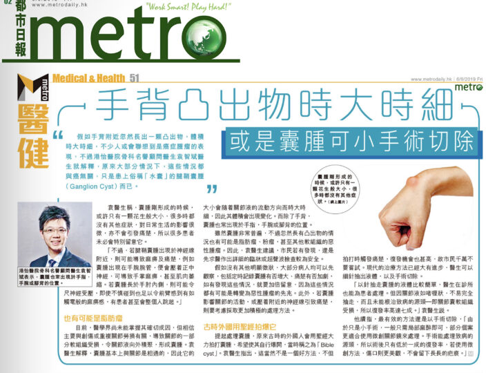 手背凸出物時大時細 或是囊腫可小手術切除
